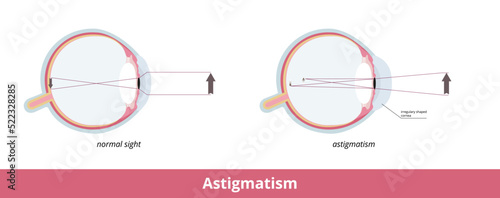 Astigmatism. A common imperfection in the curvature of the eye that causes blurred distance and near vision. The cornea or the lens has mismatched curves. Sight pathology.