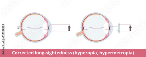 Corrected long-sightedness (hyperopia, hypermetropia). Eye condition affects the ability to see nearby objects, they are out of focus. May be corrected with glasses or contact lenses.