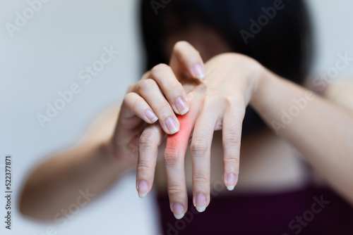 Woman s knuckle pain  Signs of osteoarthritis.