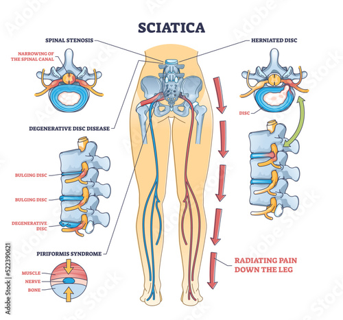 Sciatica pain or nerve weakness as leg lumbar radiculopathy outline diagram. Labeled educational back inflammation, piriformis syndrome and degenerative spinal disc problem vector illustration. photo