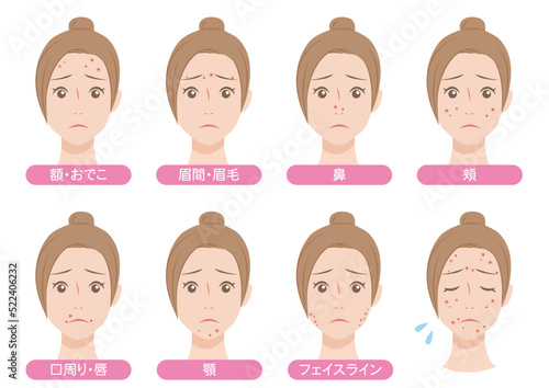 顔のニキビの出来やすい場所・女性