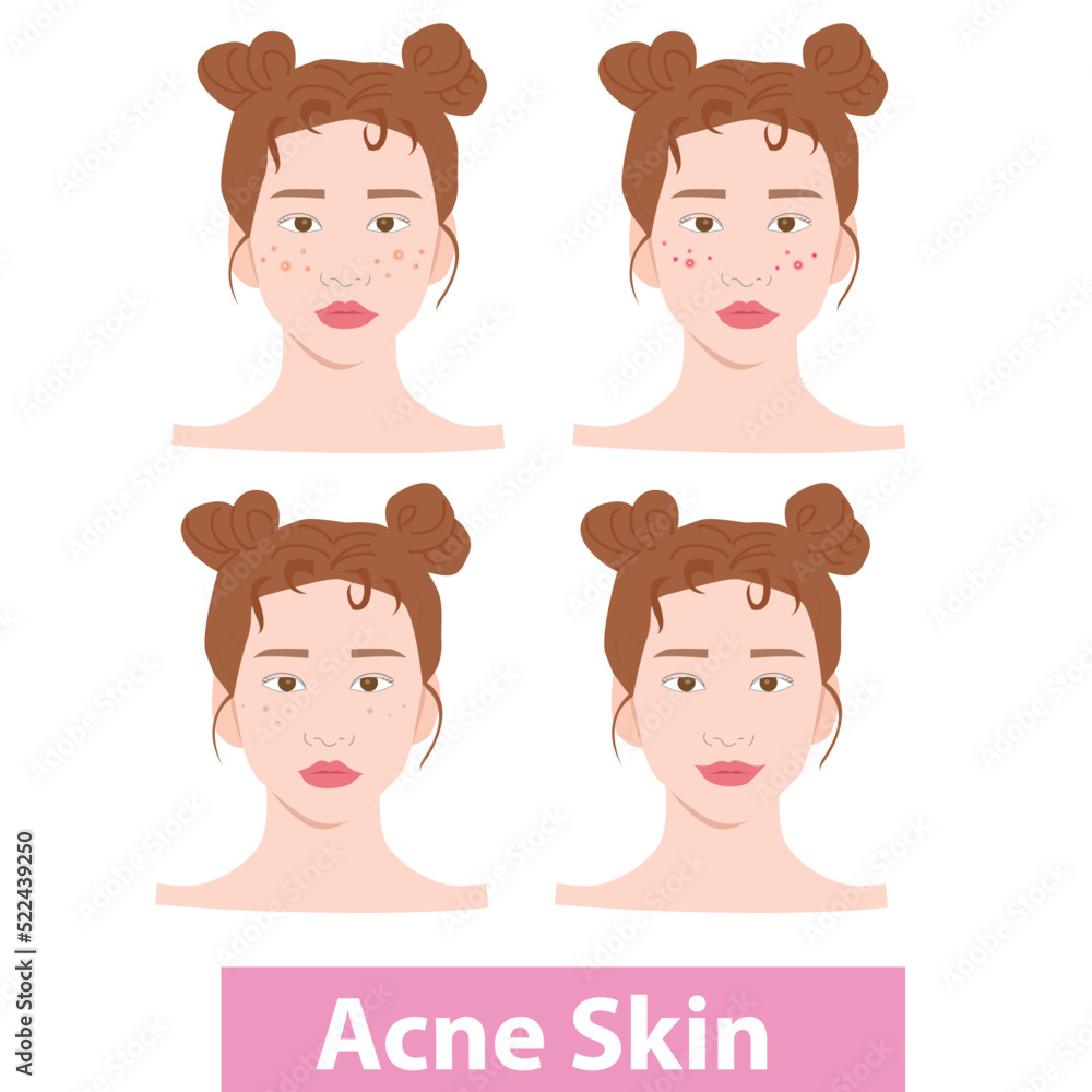 Acne becomes a beautiful face. Vector illustration. EPS8 Acne becomes a beautiful face. Vector illustration. EPS8