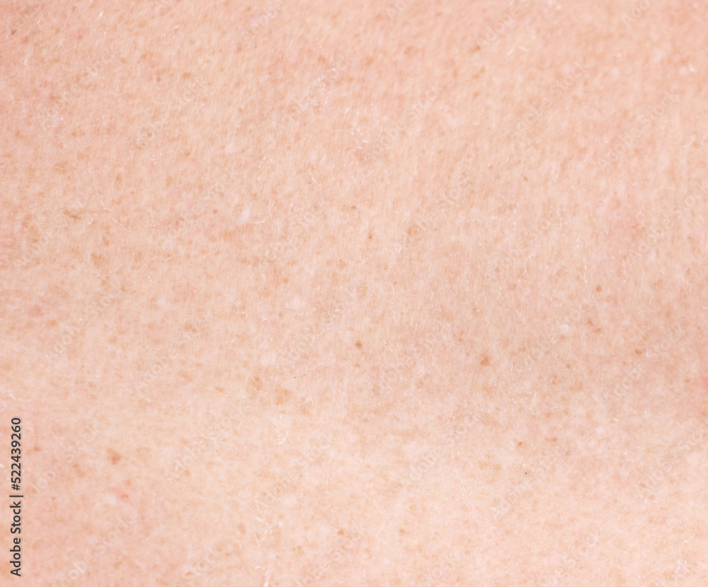 Freckles on the skin of the back Freckles on the skin of the back