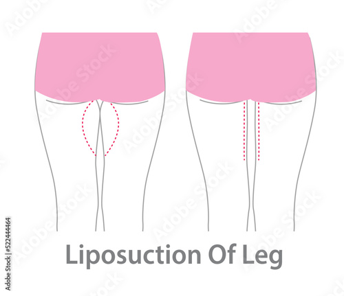 Fat leg with line for liposuction. Cellulite removal. liposuction of leg, Fat Leg.