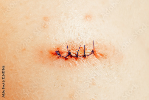 Medical sutures after operations, sewn surgical sutures on the human body