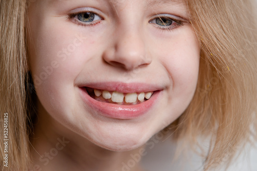 Girl shows teeth with a gap, malocclusion