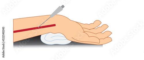 Radial artery puncture illustration. Showing correct  catheter position