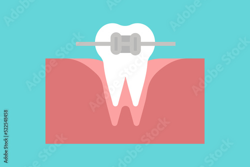 Vector Orthodontics. Tooth with metal braces and bracket system. Dental icon. Web pictogram for dentistry. Stomatology concept, logo or illustration. Orthodontist orthopedist specialization emblem.