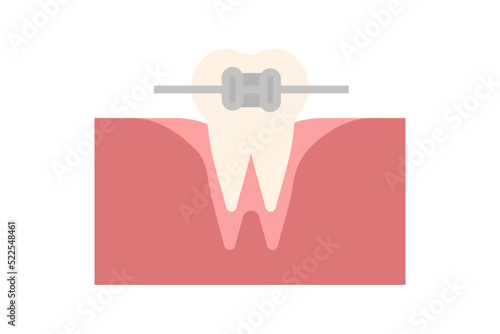 Vector Orthodontics. Tooth with metal braces and bracket system. Dental icon. Web pictogram for dentistry. Stomatology concept, logo or illustration. Orthodontist orthopedist specialization emblem.