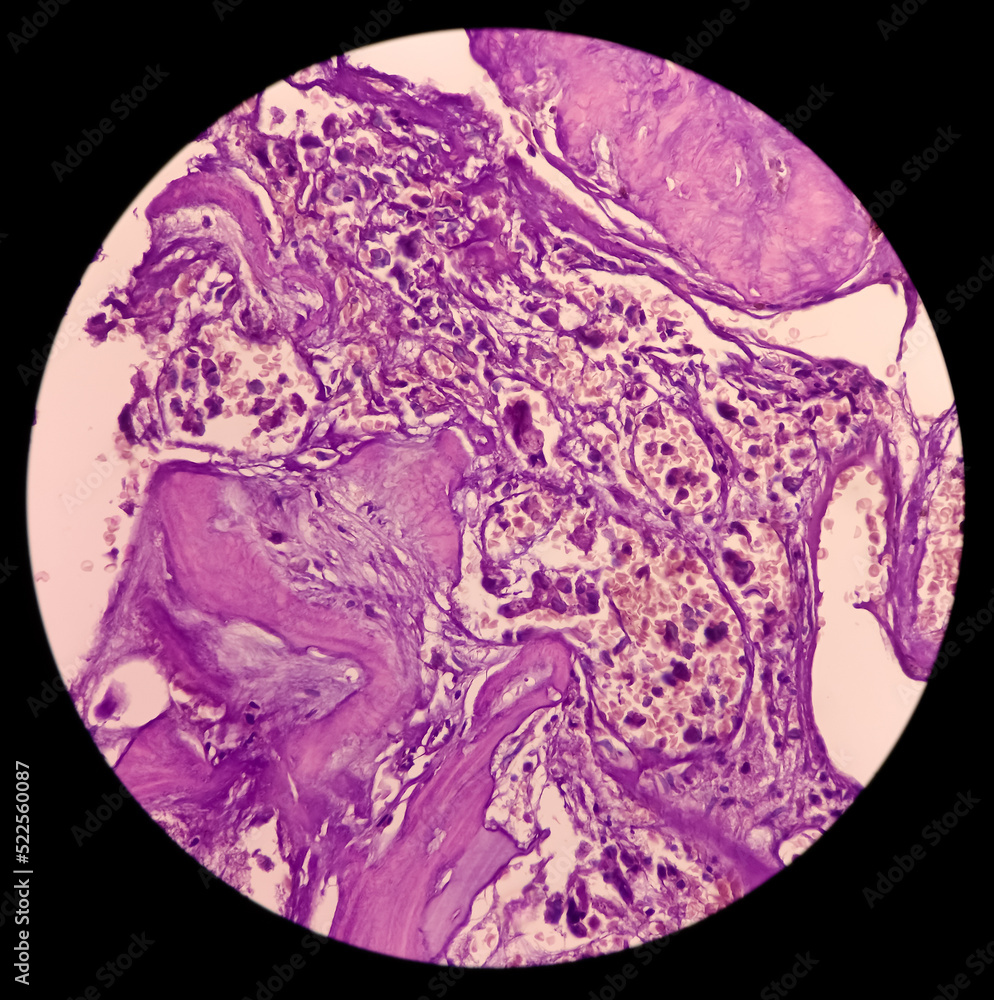 Microphotograph of sacral SOL, Chordoma. Show soft and bony tissue, malignant neoplasm, mucoid intercellular tissue, physaliferous cells, vacuolated cytoplasm. Microphotograph of sacral SOL, Chordoma. Show soft and bony tissue, malignant neoplasm, mucoid intercellular tissue, physaliferous cells, vacuolated cytoplasm.