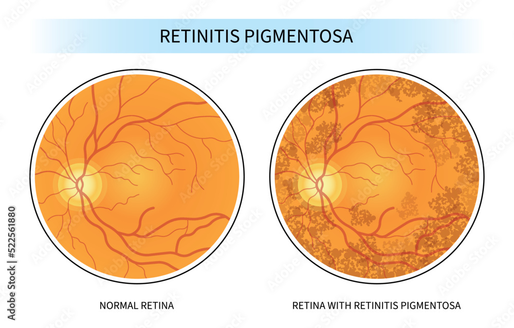 retinal degenerative and Blurry vision of Age related Blind spots with