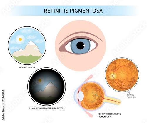 Anatomy of retinal degenerative and Blurry vision of Age related Blind spots with cone rod dystrophy