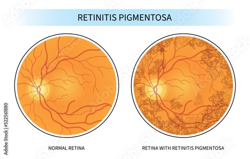 retinal degenerative and Blurry vision of Age related Blind spots with cone rod dystrophy