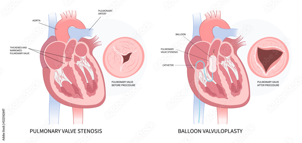 left atrial atresia and heart rhythm syndrome cardiac murmur disease Cath lab for TAVI or TAVR stroke aortic repair right fever mitral valve floppy with Barlow birth atrium balloon surgery left atrial atresia and heart rhythm syndrome cardiac murmur disease Cath lab for TAVI or TAVR stroke aortic repair right fever mitral valve floppy with Barlow birth atrium balloon surgery