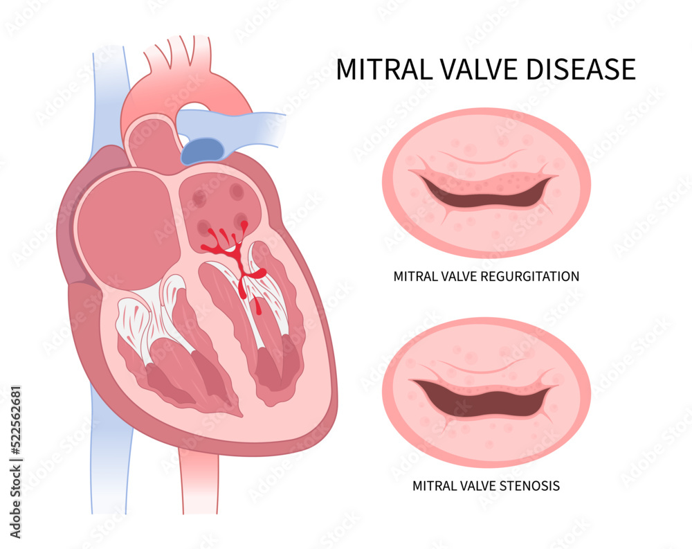 aortic repair of right atrium cardiac heart murmur disease Cath lab for