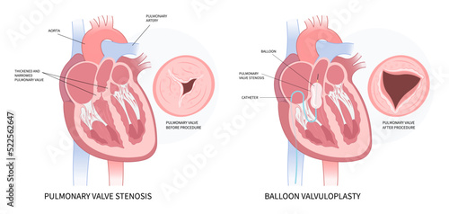 left atrial atresia and heart rhythm syndrome cardiac murmur disease Cath lab for TAVI or TAVR stroke aortic repair right fever mitral valve floppy with Barlow birth atrium balloon surgery
