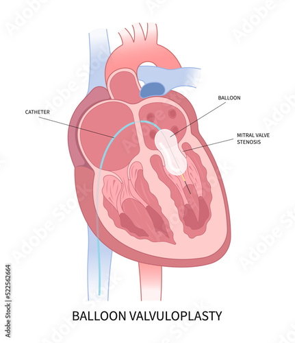 atrium balloon surgery and cardiac heart murmur disease Cath lab for TAVI or TAVR stroke aortic repair right left atrial fever atresia mitral valve floppy with Barlow birth syndrome rhythm