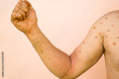 Obraz na plátně Monkeypox new disease dangerous over the world