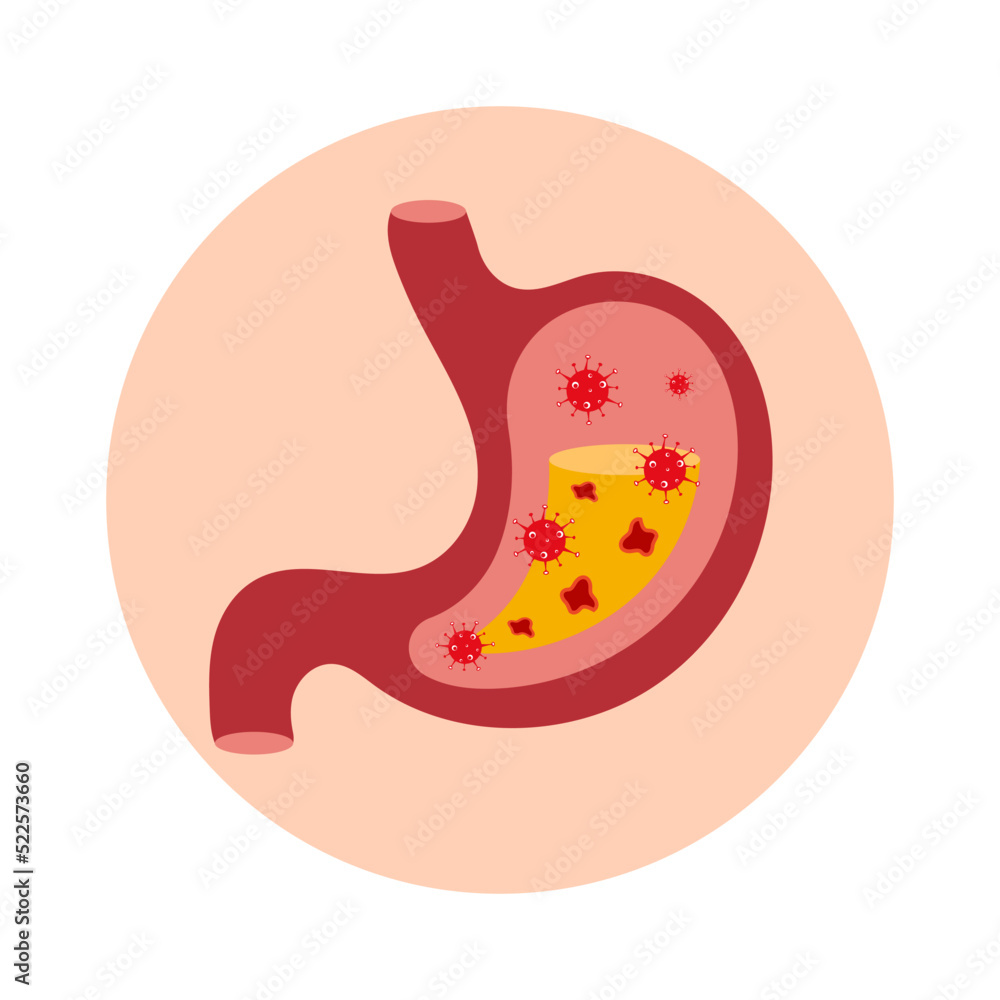 The stomach is filled with bacteria and ulcers. The stomach is filled with bacteria and ulcers.