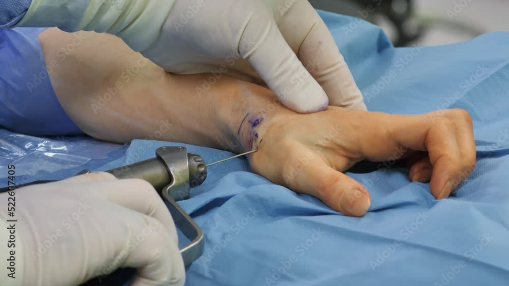 Team surgeon at work in operating room. Modern equipment in operating room. Medical devices for neurosurgery. Team surgeon at work in operating room. Modern equipment in operating room. Medical devices for neurosurgery.