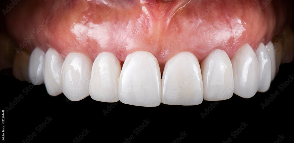 dental photography of dental work ceramic crowns and veneers