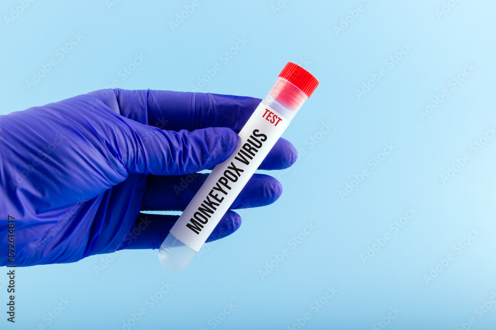Obraz premium Laboratory test with the text MONKEYPOX VIRUS in the hand of a doctor in a blue medical glove.