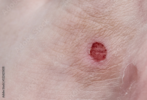 Not a big bloody wound on the skin of the leg.Damaged skin.Capillary layer.