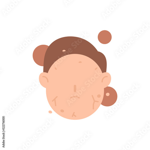 Xerosis, a dry and peeling skin condition. the skin on the face is scaly and dry. lack of moisture in the skin and lack of water content. health. flat cartoon illustration. vector concept design
