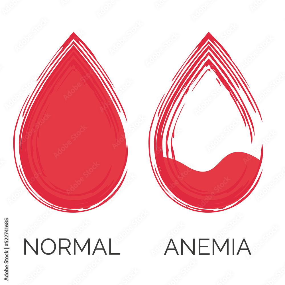 Normal and anemic drop of blood. Lack of red cells, anemia. Isolated on