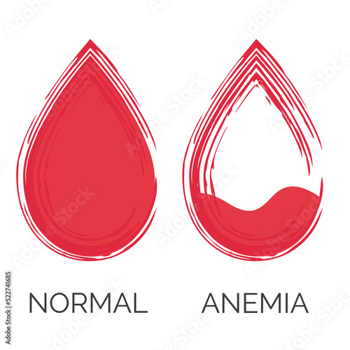 Normal and anemic drop of blood. Lack of red cells, anemia. Isolated on white background. Vector illustration