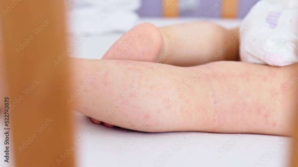 atopic eczema dermatitis sleeping baby legs, red irritation allergic ...