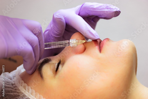 Lip augmentation procedure. Patient woman getting filler botox injection. Beautician injects collagen, hyaluronic acid, silicone through a syringe. Cosmetologist wearing purple gloves. Working process