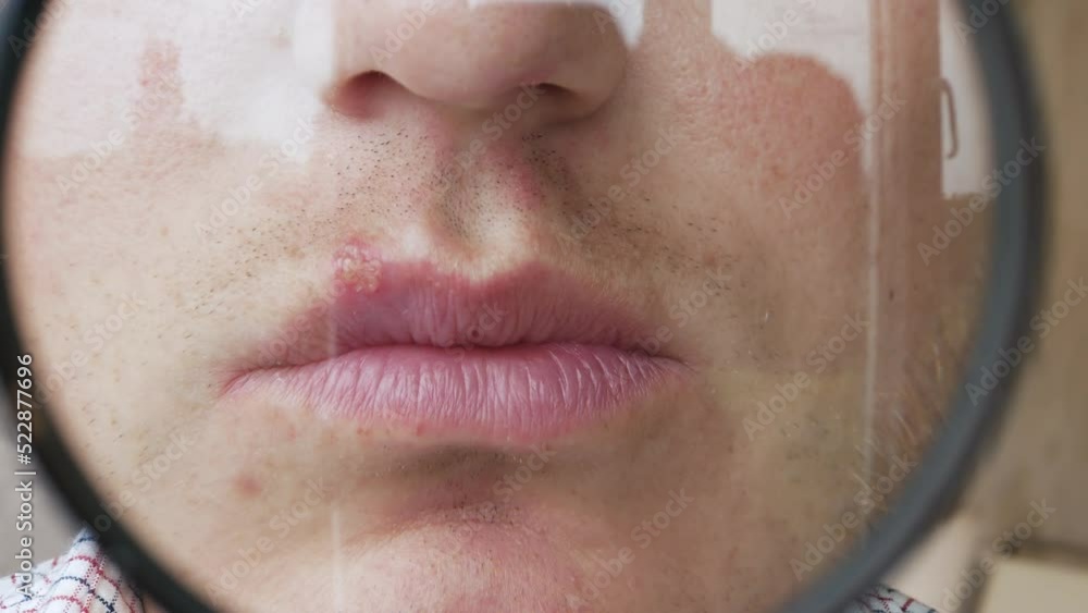 Herpes on the lip of a man through a magnifying glass, a pimple on the