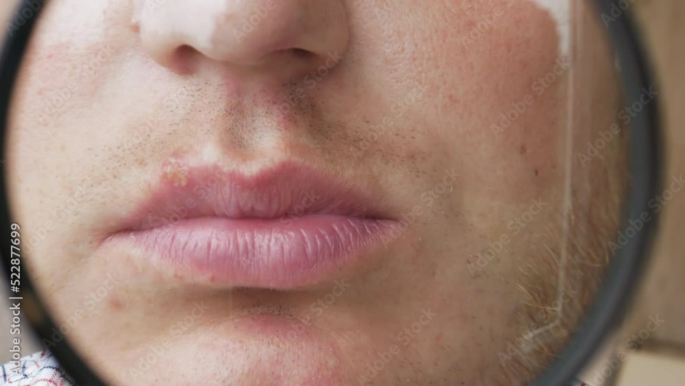Herpes on the lip of a man through a magnifying glass, a pimple on the