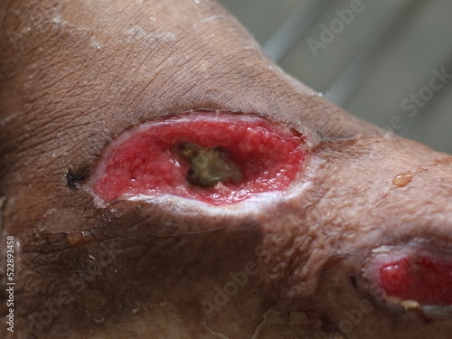 wound infaction to skin  diabetes melitus. photo