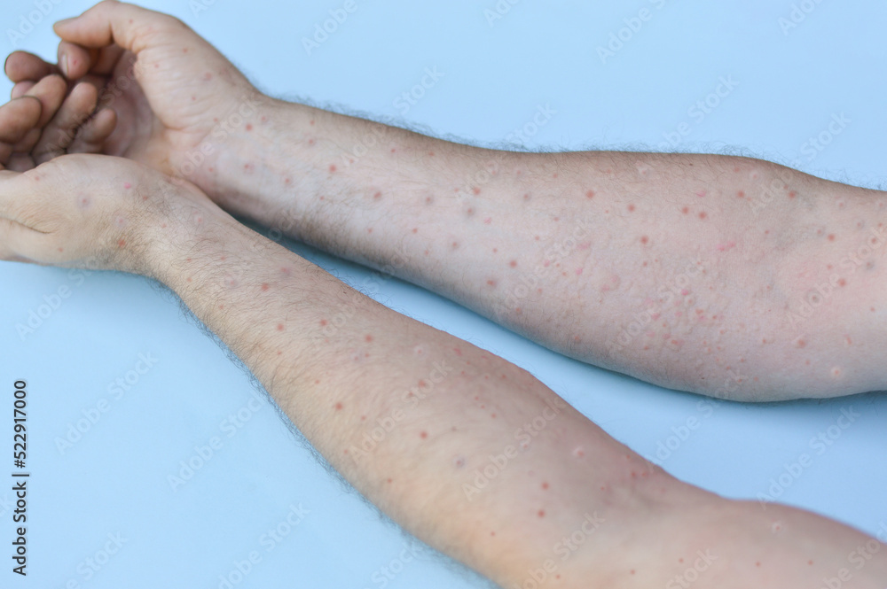 Monkeypox new disease dangerous over the world. Male hands affected by blistering rash because of monkeypox or other viral infection Monkeypox new disease dangerous over the world. Male hands affected by blistering rash because of monkeypox or other viral infection