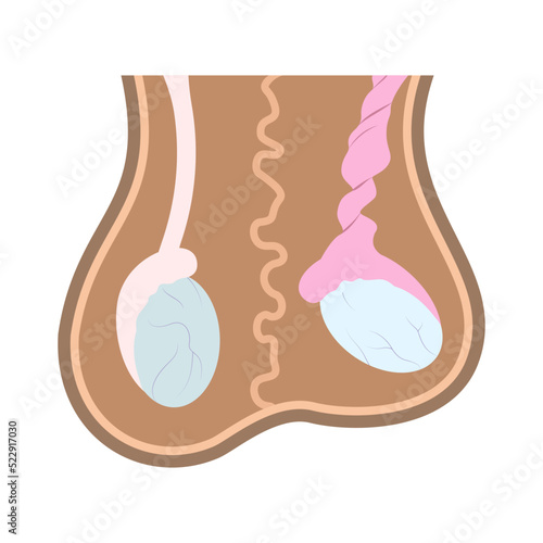 Illustration of normal testicle and testicle torsion in scrotum. Medical chart of reproductive organ anatomy.