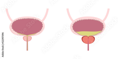 Descriptive illustration of enlarged and inflamed swelled prostate and healthy prostate.