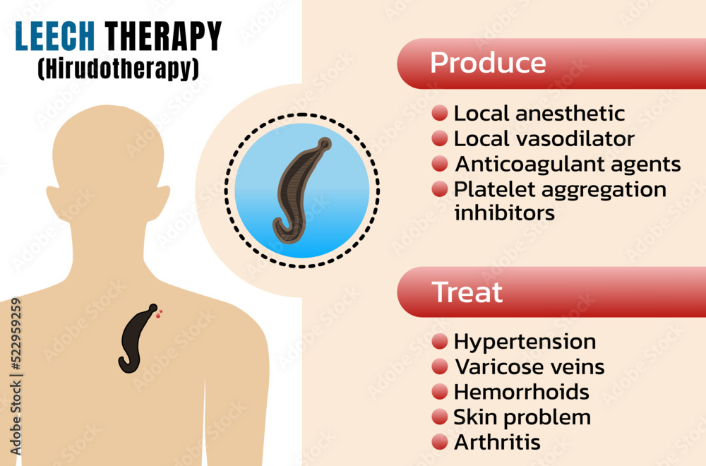 Medicinal leech therapy (MLT) or hirudotherapy Using leech to suction