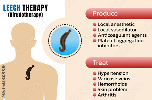 Medicinal leech therapy (MLT) or hirudotherapy Using leech to suction blood from human body photo