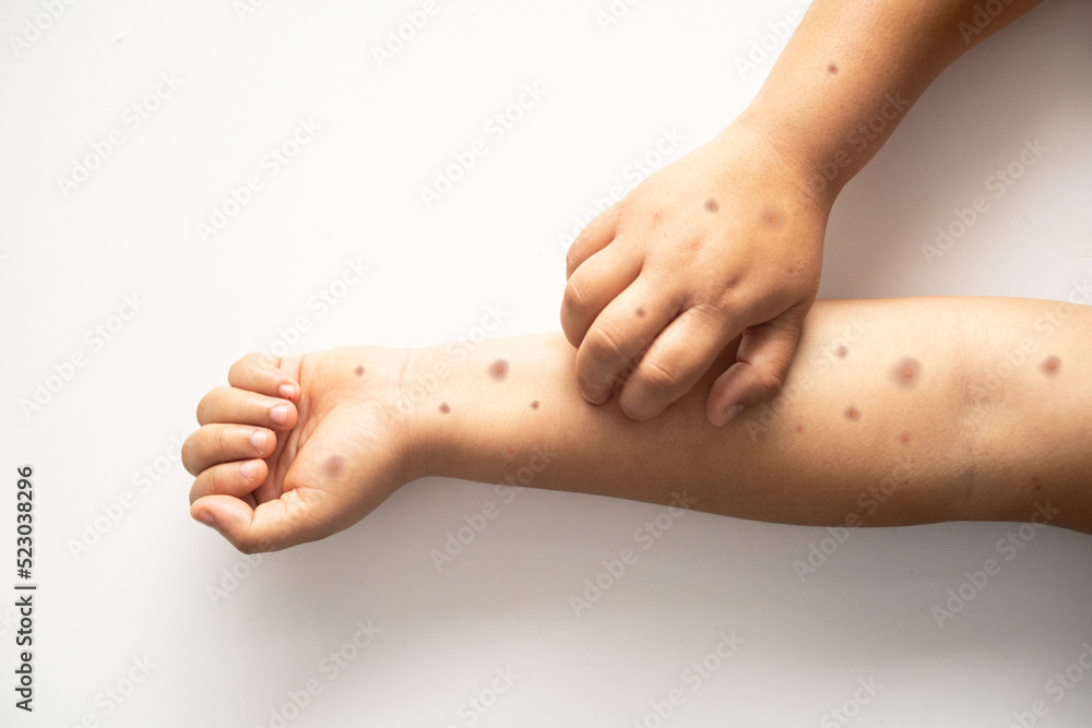New monkeypox disease. Brunette woman with monkey pox. Painful rash ...