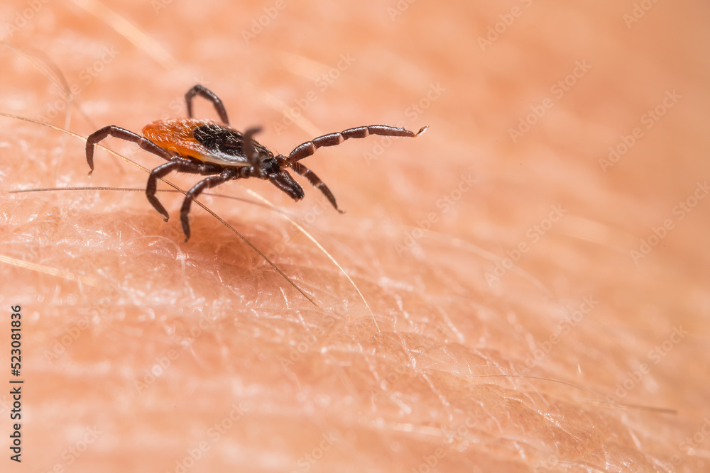 Closeup of running parasitic deer tick on textured human skin. Ixodes ricinus. Dangerous insect parasite in dynamic motion between hairs on blurry background. Carrier of encephalitis and Lyme disease. Closeup of running parasitic deer tick on textured human skin. Ixodes ricinus. Dangerous insect parasite in dynamic motion between hairs on blurry background. Carrier of encephalitis and Lyme disease.