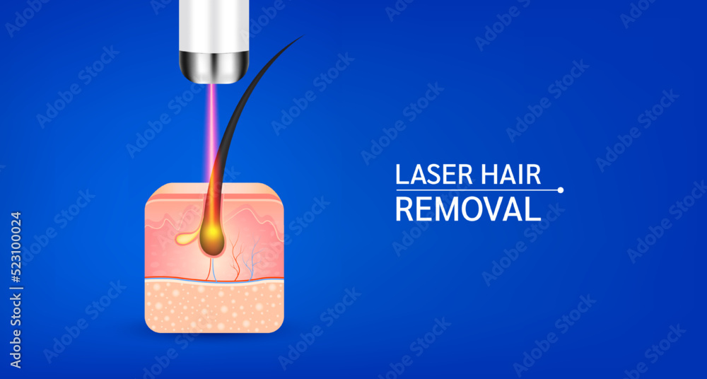Skin layers anatomy with hairs and yellow laser light hair removal