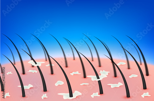 Dandruff in hair on scalp. Dermatitis occur due bacteria, fungus or pimples on the head. Layers of the human skin. Medical beauty concept. 3D Realistic vector. Used for beauty clinic advertisements.