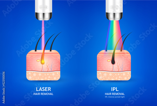 Skin layers anatomy with hairs. Laser and IPL light (Intense Pulsed Light) hair removal. Unwanted out make skin smooth. Used for beauty advertisements. Medical science concept. 3D Realistic vector.