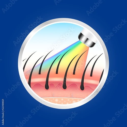 IPL light (Intense Pulsed Light) and laser hair removal unwanted out make skin smooth. Medical beauty concept. 3D Realistic vector EPS10. Silver labels are used for product label design.