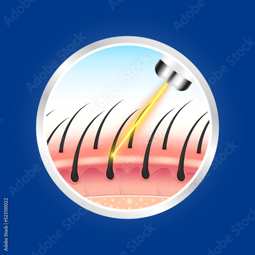 Yellow laser light hair removal unwanted out make skin smooth. Medical beauty concept. 3D Realistic vector EPS10. Silver labels are used for product label design.