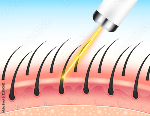 Yellow laser light hair removal unwanted out make skin smooth. Medical beauty concept. 3D Realistic vector EPS10.