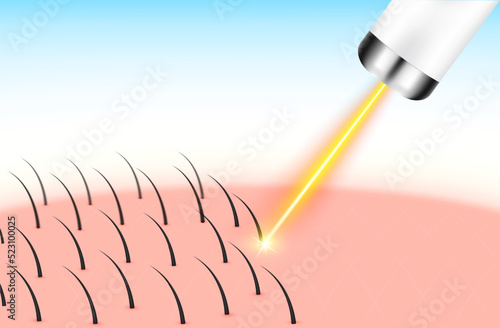 Yellow laser light hair removal unwanted out make skin smooth. Medical beauty concept. 3D Realistic vector EPS10.