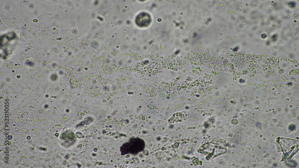 Coughing up mucus and phlegm from a chest infection from a virus and